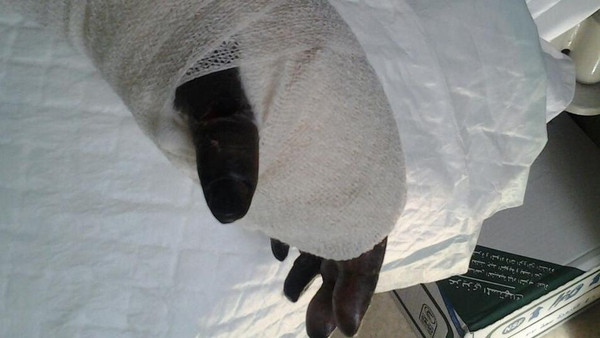 زينة ابراهيم دخلت مستشفى محايل العام للوز وخرجت بلا يد